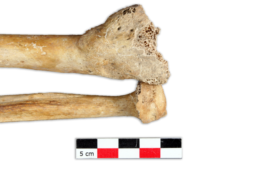 Une fracture déplacée des os de l’avant-bras droit, juste au-dessus du poignet. L'os s'est consolidé et présente un cal osseux. La fracture n’a pas été réduite car l’os n’est plus en position anatomique, ce qui devait provoquer une gêne dans les mouvements de l’articulation du poignet.