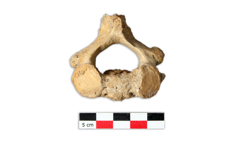 Une fracture de la 2ième vertèbre cervicale caractérisée par une surface cicatricielle.